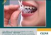 invisible-clear-aligners